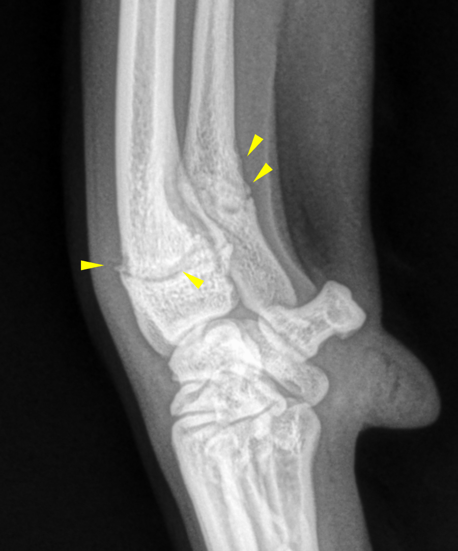 RAD - Old traumatic growth plate injury of radius and ulna with ...
