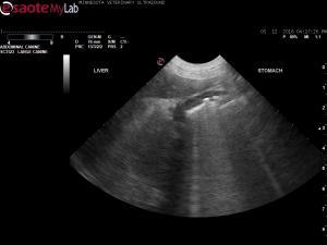 Ascites and reactive echogenic fat adjacent to the liver in a 14 year old MN Lab
