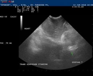 Esophageal mass or hiatal hernia