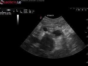 Extrahepatic biliary obstruction in a 4 year old FS DSH