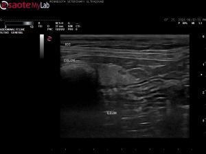 Echogenic fat at the ileocolic junction
