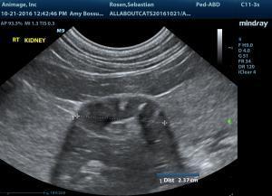 Atypical renal calcification left kidney, small right kidney, dilated left ureter?