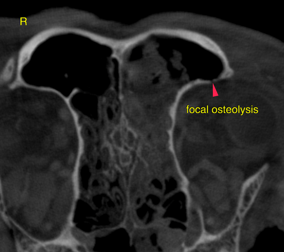 CT - Mycotic rhinitis with conchal and turbinate destruction in a 12 ...