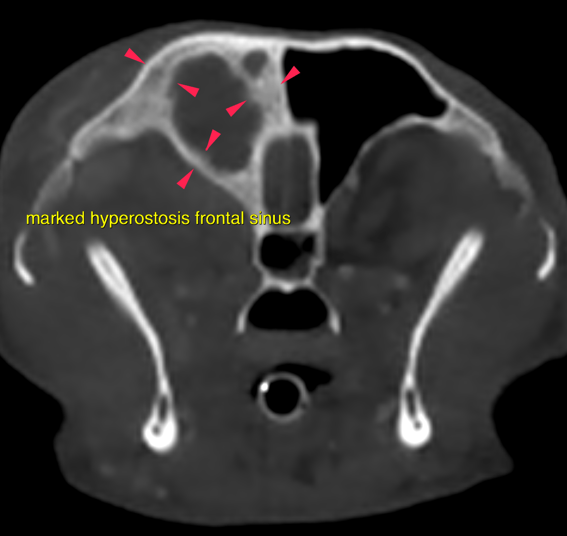 CT - Mycotic rhinitis and complete destruction of conchal and nasal ...