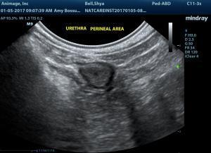 Imaging for vaginal mass urethral papilla