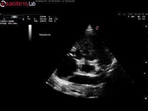 Right to left VSD,  right ventricular hypertrophy, and RA dilation in a young pitbull