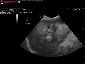 Complex cystic liver mass in a jaundiced 15 year old FS DLH