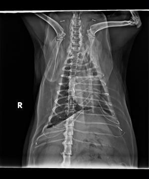 Dilated Cardiomyopathy