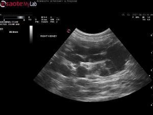Polycystic kidney disease in an approximately 10 year old MN cat with crf
