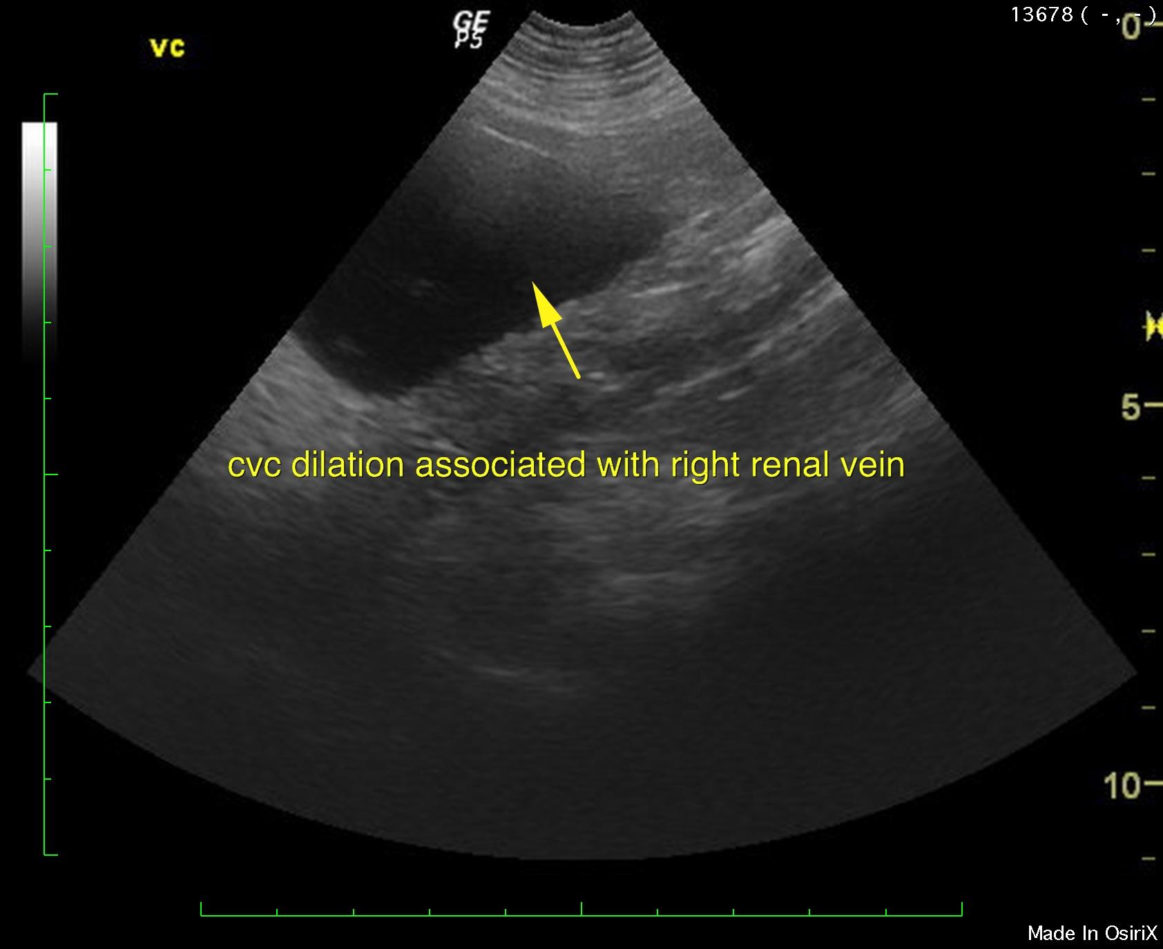 Uterine stump pyometra and CVC vascular anomaly in a 11 year old FS