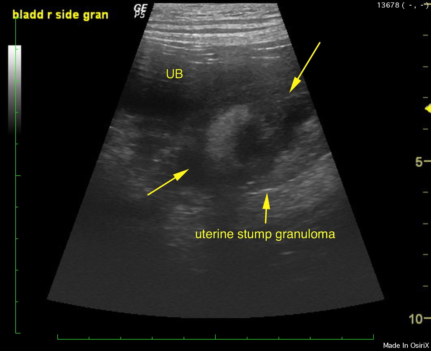 Uterine stump pyometra and CVC vascular anomaly in a 11 year old FS