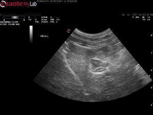 Small, abnormal gallbladder in a year 13 year old MN DSH
