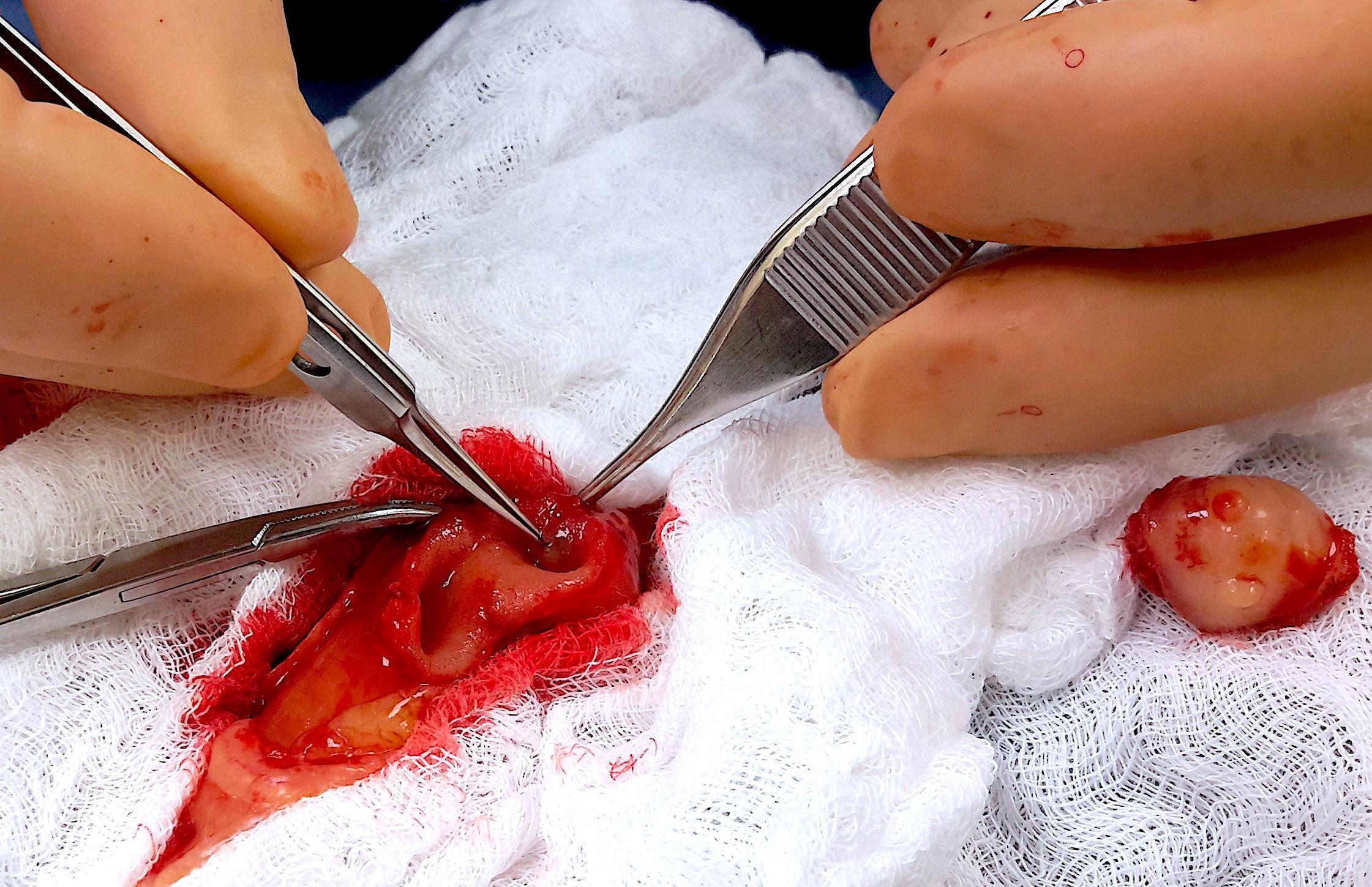 removing_the_cholelith_at_time_of_surgery