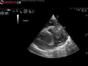 Aortic body tumor or HSA