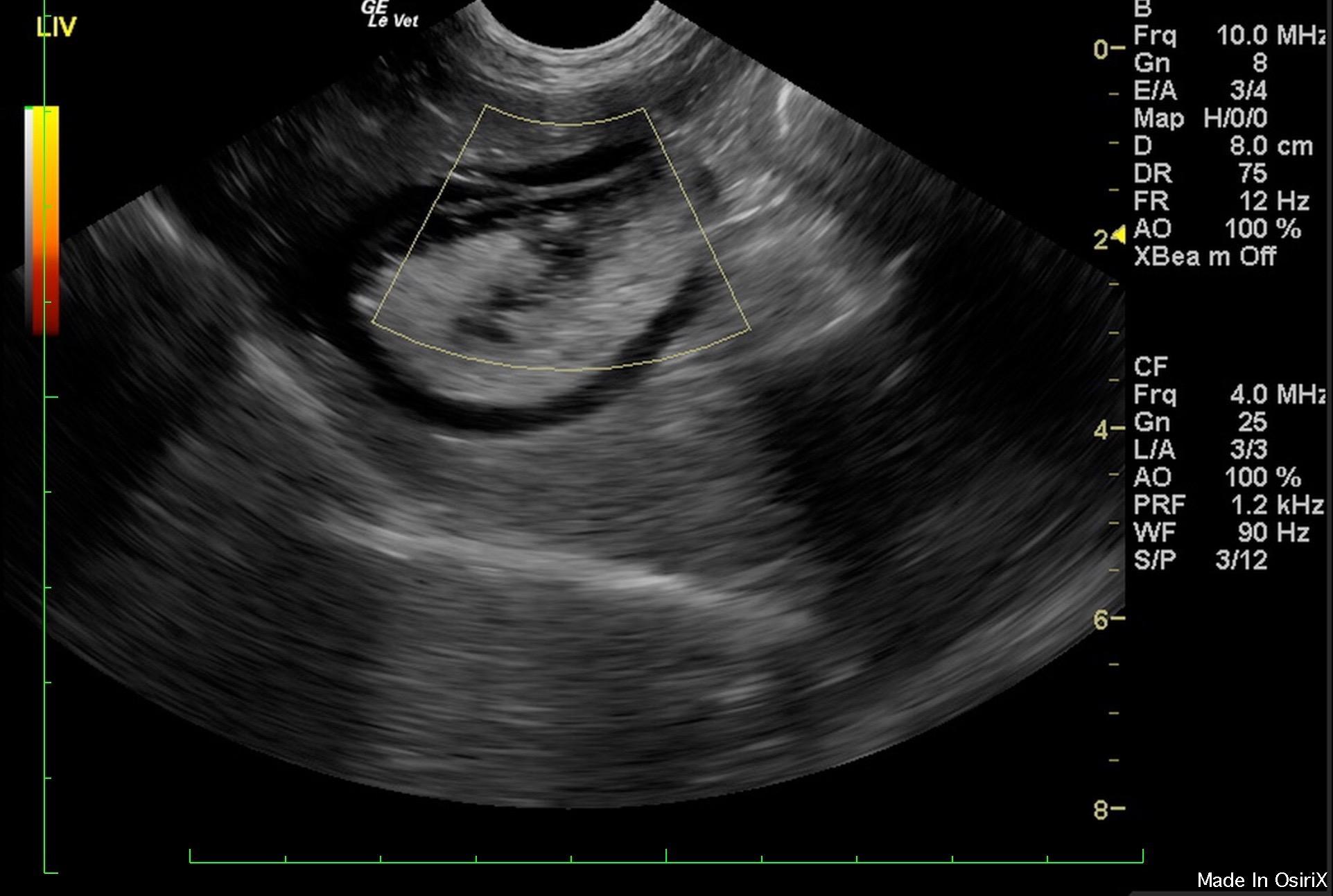 Right auricular and right ventricular mass with tamponade, likely ...