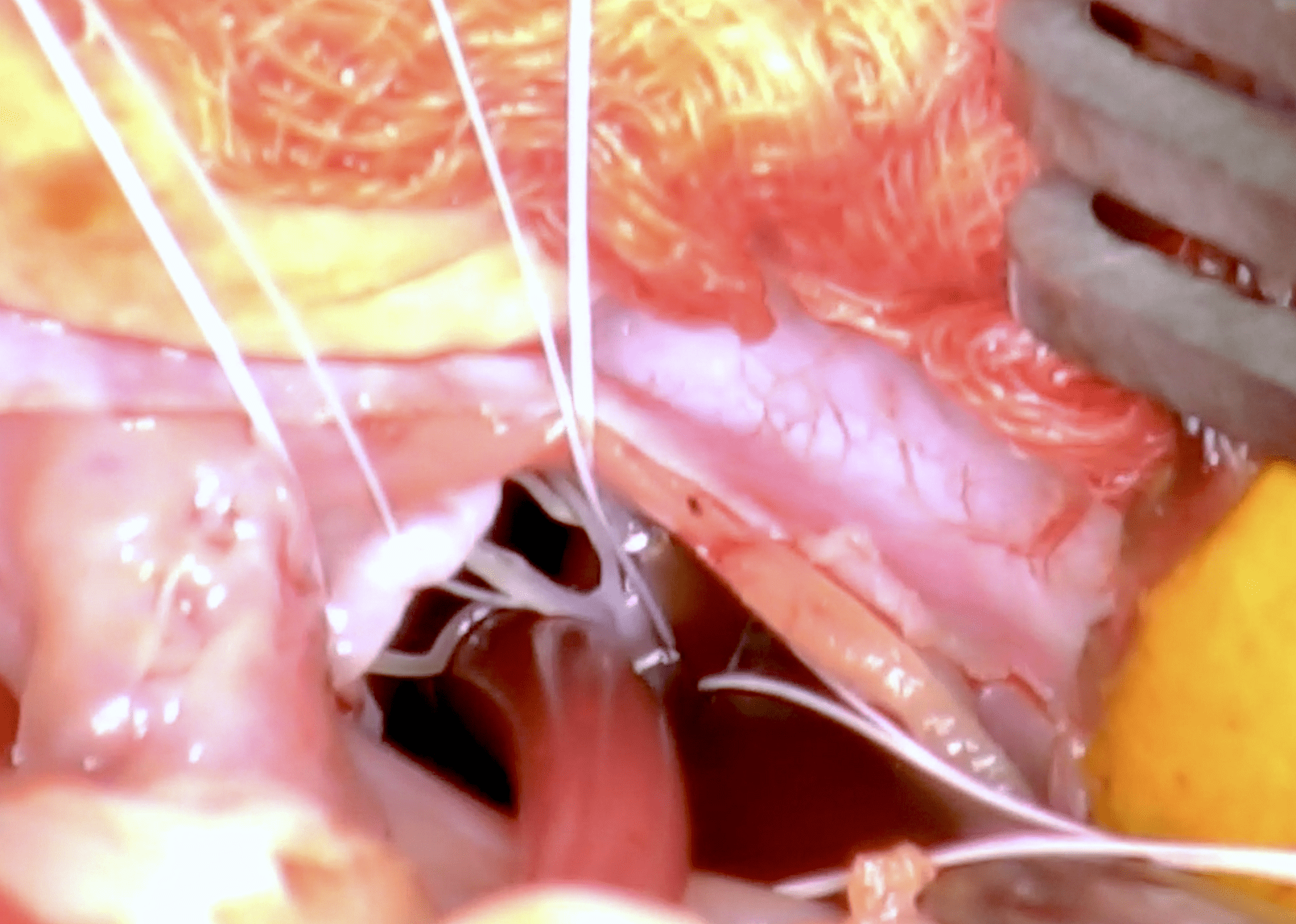 sutures_and_senn_peter_2017_screen_shot_2017-11-01_at_12