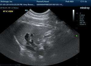 Intrahepatic shunt VS portal vein hypoplasia