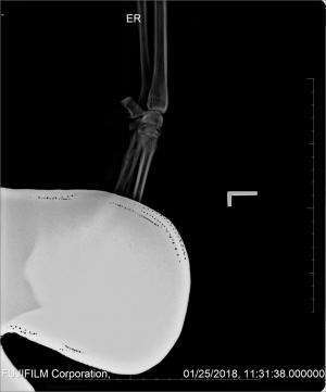 Firm, soft tissue swelling at a metacarpal-phalangeal joint