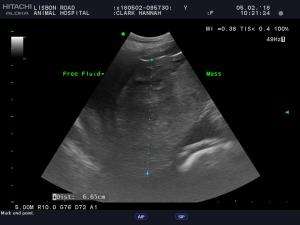 FNA Spleen, any contraindications?