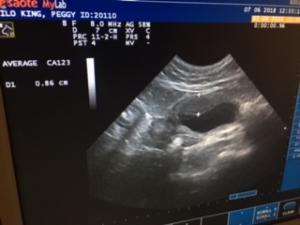 Bladder Wall Thickening