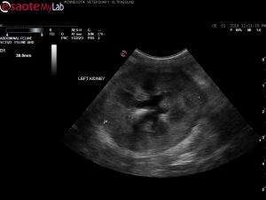 Perirenal inflammation and renal pelvic dilation