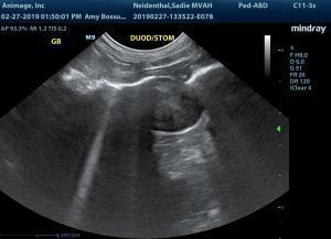 Pyloric duodenal mass
