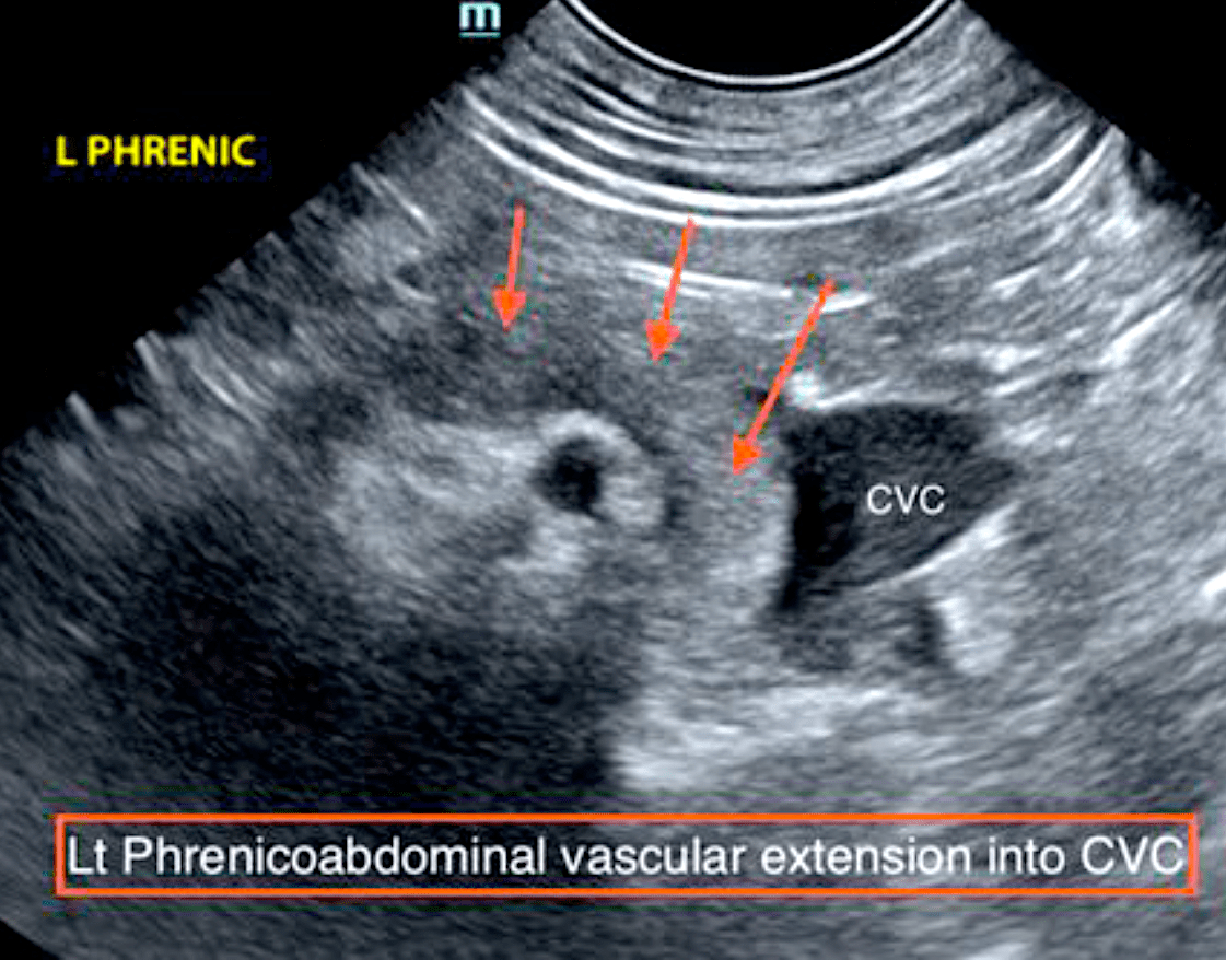 left_phrenicoabdoninal_vascular_extension_into_cvc_left_phrenic_jack_butler_2019_screen_shot_2019-03-25_at_3