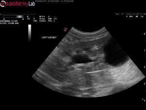Ureteral stent in a 12 yr old MN Yorkie with TCC