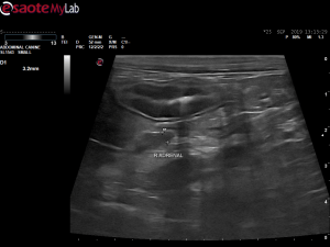 Adrenomegaly