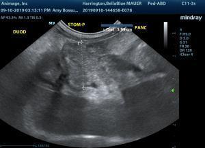 Pancreatitis and odd cyst and duodenal lesion