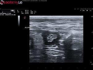 Thickened muscularis in an asymptomatic DSH
