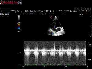 Pulmonic stenosis EBD