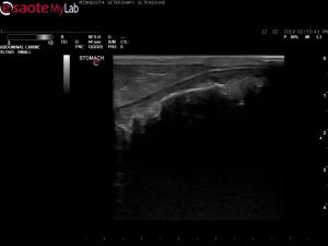 Strongly shadowing gastric luminal material
