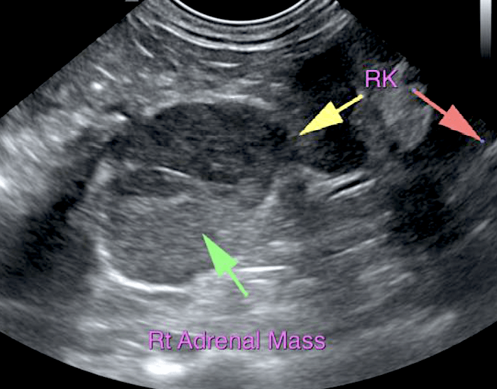rt_adrenal_and_rt_kidney_2020_screen_shot_2020-05-18_at_12