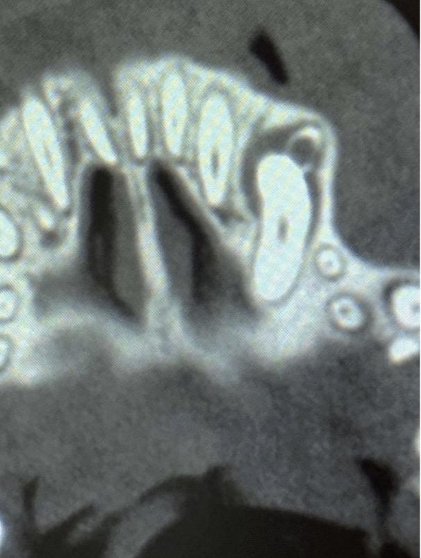 cystic_changes_over_the_crown_starting_from_the_unerupted_tooth_with_the_retained_baby_canine_root_visible