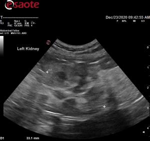 Abnormal renal structure in 9 yr old mn DLH