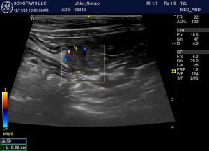 GI Masses ileocolic junction and jejunum