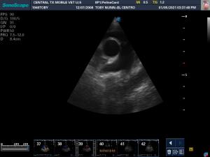 Aortic insufficiency