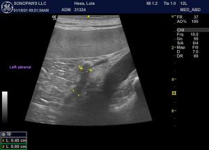 Bilateral masses near adrenals and lumbar aorta