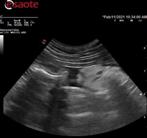 Thickened colonic wall in 11 year old DMH