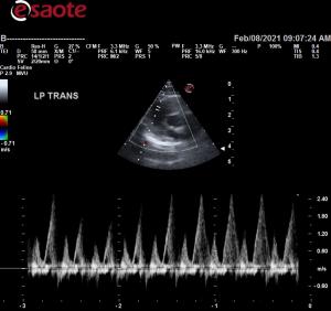 High velocity tricuspid inflow on 17 yr old cat