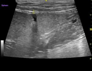 Small tear in the spleen?