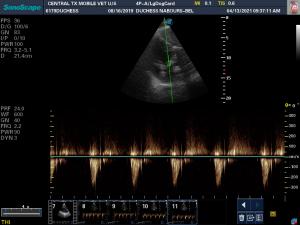 Aortic regurgitation