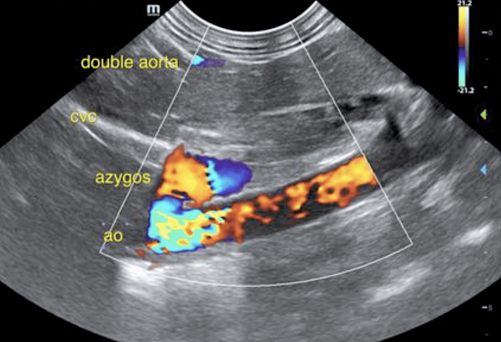 double_aorta_cvc_azygos_ao_screen_shot_2021-04-29_at_10