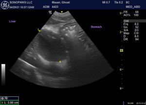 Hepatic abscess?