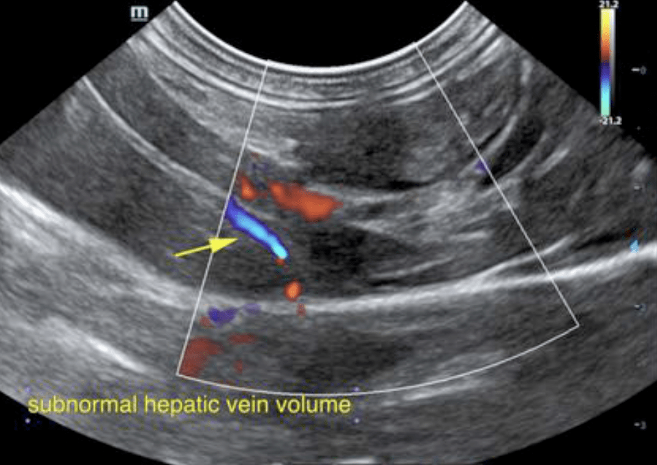 sub_normal_hepatic_vein_volume_screen_shot_2021-04-29_at_10