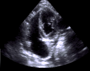 Cat restrictive cardiomyopathy (RCM)? non classified ?