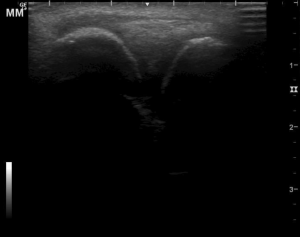 Meniscus extrusion? (Lateral)