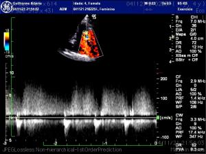 PDA or another vascular anomaly?