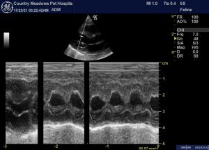 Pleural effusion -Heart Failure?